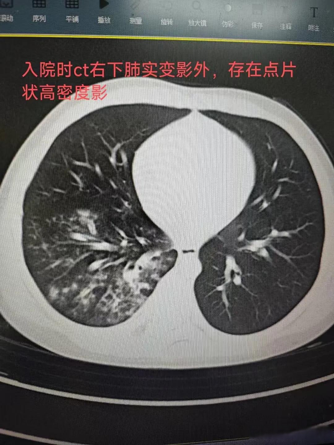 「2019年新型肺炎爆发」〃2019新型冠状病毒肺炎-第2张图片